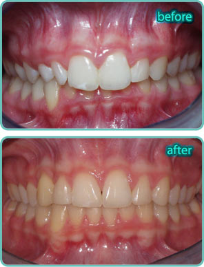 Overbite - Before & After