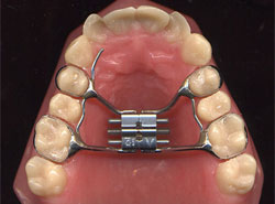 Orthodontic Expanders - Banded