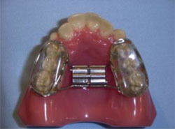 Orthodontic Expanders - Bonded