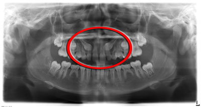 Impacted Teeth