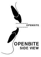 Openbite