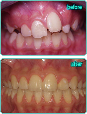 Spacing of the Teeth - Before & After