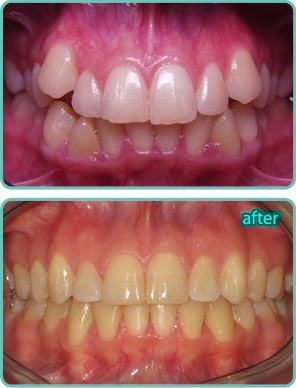 Spacing of the Teeth - Before & After