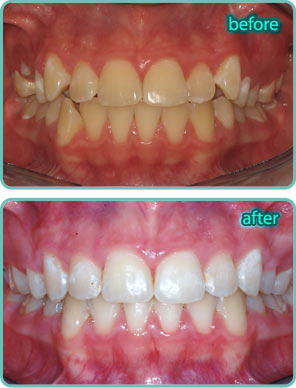 Spacing of the Teeth - Before & After