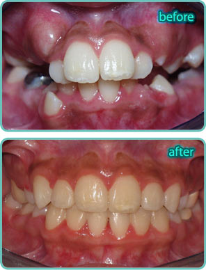 Spacing of the Teeth - Before & After