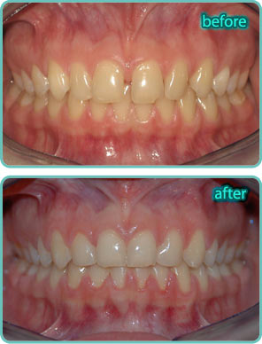 Spacing of the Teeth - Before & After