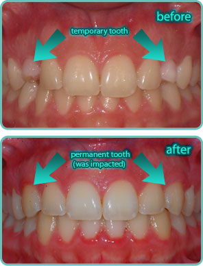 Impacted teeth