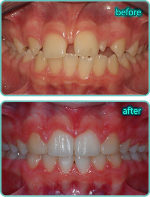 Spacing of the Teeth - Before & After