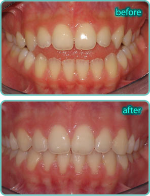 Operbite - Before & After