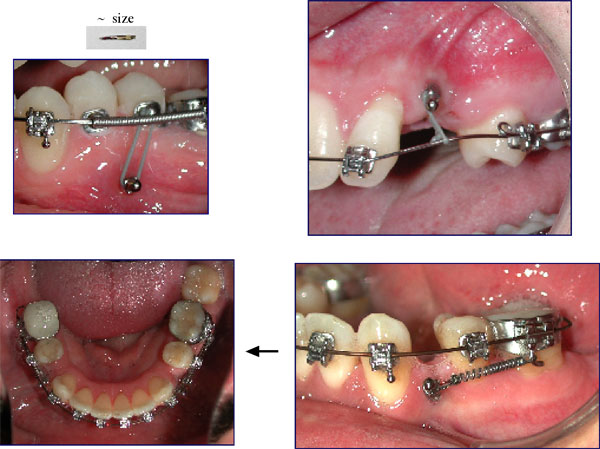 Orthodontic Implants