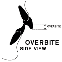 Overbite or Deep Bite