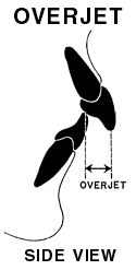 Overjet or Protrusion